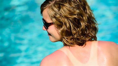 Put Out The Fire Tips For Treating Sunburn Ohio State Wexner Medical