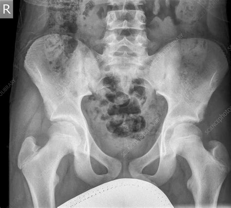 Adult Male Pelvis X Ray