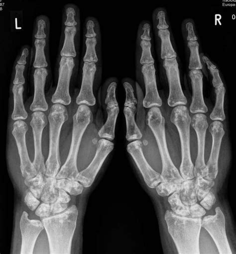 Typically, osteopathia striata is diagnosed based on its characteristic findings on imaging. Osteopoikilosis | Radiology Case | Radiopaedia.org ...