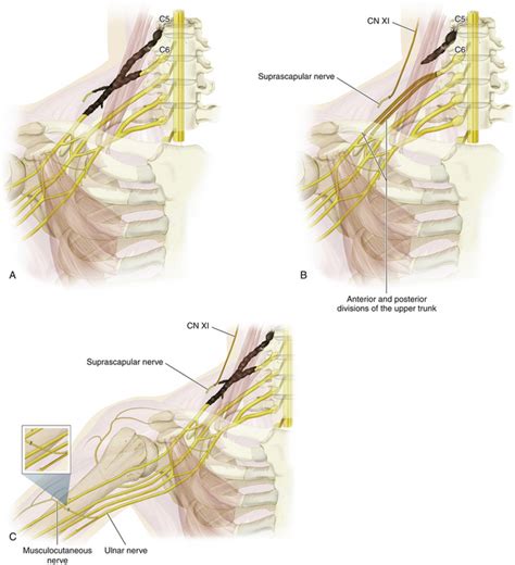 Brachial Plexus Injury Types Clinical Gate