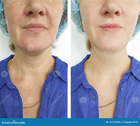 Woman Neck Wrinkles Before After Treatment Removal Stock Image Image