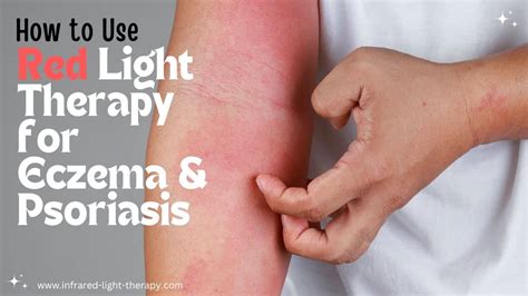 How To Use Red Light Therapy For Eczema And Psoriasis