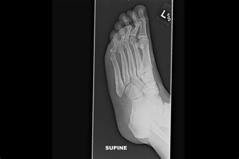 Ortho Dx Progressively Worsening Foot Pain Clinical Advisor