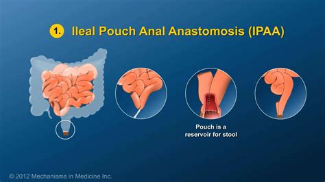 Small Bowel And Large Bowel Surgery Youtube