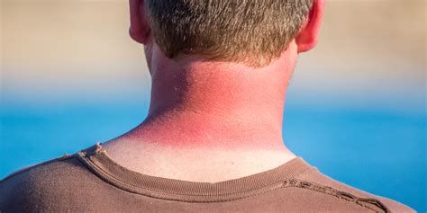 Getting Really Bad Sunburns As A Teen Could Raise Skin Cancer Risk