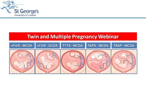 How To Assess Fetal Growth In Twins St Georges University Hospitals