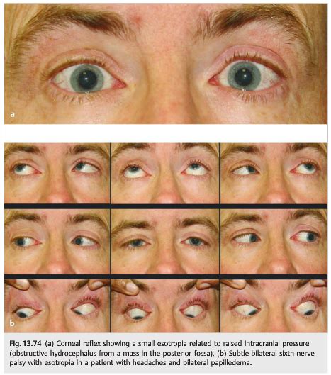 Neuro Ophthalmology Illustrated Chapter 13 4 6th Nerve Palsy
