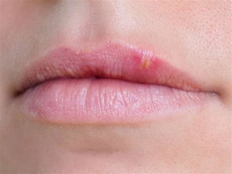 White Spots On Lips Causes Pictures Small On Lower Upper Inside