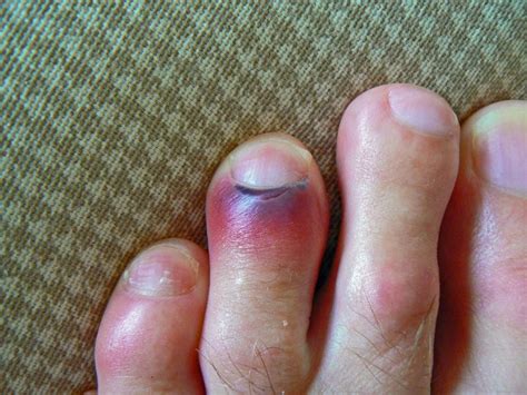 Whats Causing My Purple Toes And Should I Be Concerned