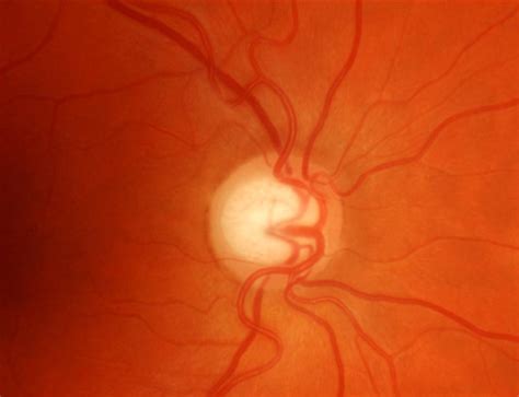 Retinal Imagingphotos