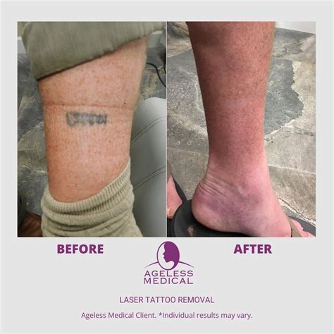 Does Laser Tattoo Removal Leave Scars Ga Fashion