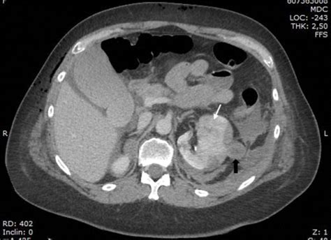 Spontaneous Subcapsular And Perirenal Haemorrhage With Retroperitoneal