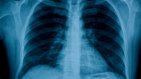 Chest X Rays Miss ‘nearly A Quarter Of Lung Cancers In Uk The Signs