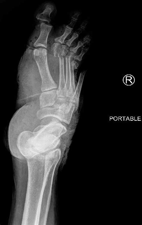 Plain Film X Ray Of The Patients Crushed Foot Obtained In The Trauma
