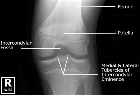 Knee Trauma Radiographic Anatomy Wikiradiography Vrogue Co