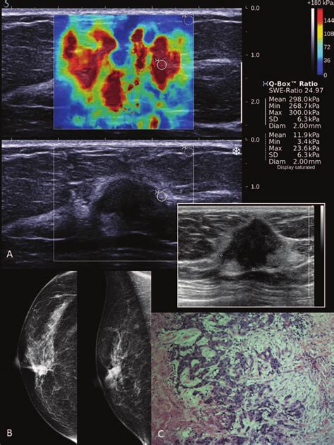 Shearwave Elastography Swe Of A Breast Imaging Reporting And Data