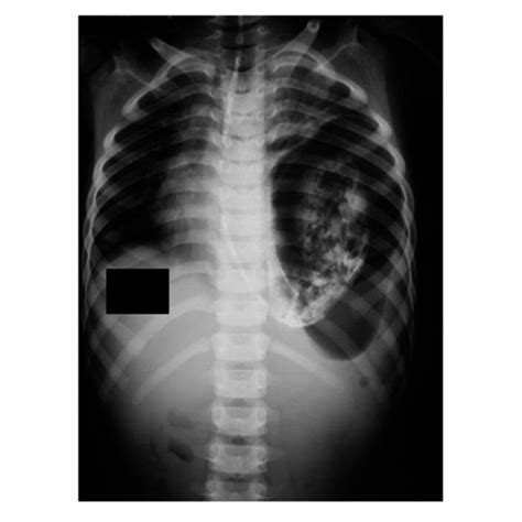 The Follow Up Chest X Ray Shows A Normal Mediastinum With The Gastric