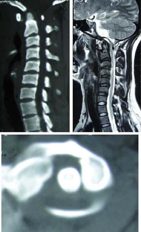 Atlantoaxial Rotatory Dislocation Due To Spasmodic Torticollis The Spine Journal