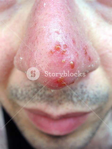 Herpes On Nose Tip