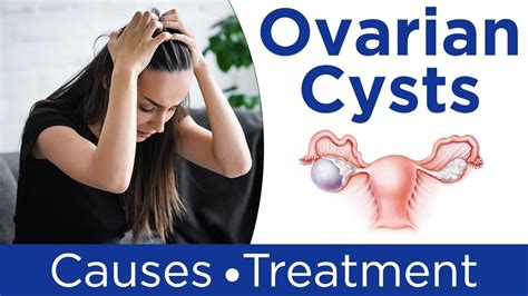 ️ What Are Ovarian Cysts 💹ovarian Cysts Symptoms Causes And