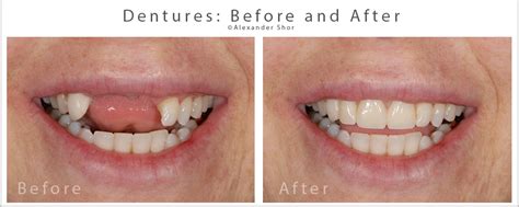Dentures Before And After Seattle Shor Dental