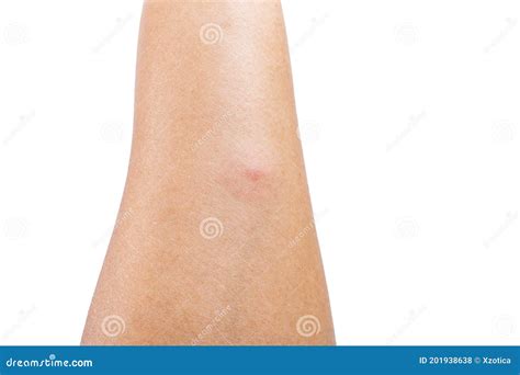 Photo Of Red Spot Swollen And Allergies From Insect Bites On Human Arm