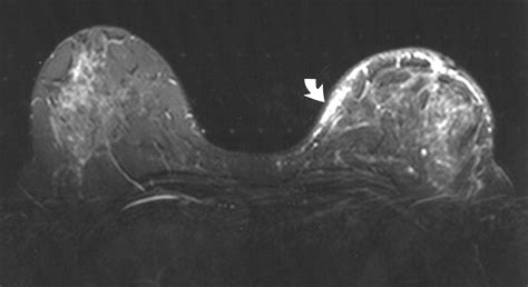 Breast Mri For Cancer Detection In A Patient With Diabetic Mastopathy Ajr