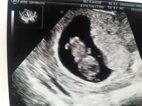 Baby's heartbeat is audible on ultrasound. First ultrasound 9weeks 3days - Weddingbee