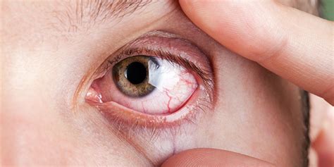 Burning Eyes 5 Reasons Behind This Irritating Health Symptom Self