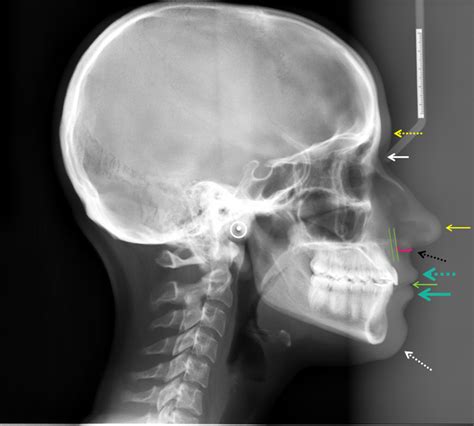 Lateral Cephalometric Skull Anatomy Part Vi Dr Gs Toothpix