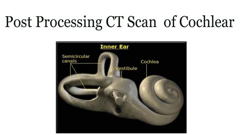 Ct Scan Of Cochlear Post Processing Youtube