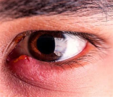 White Bump On The Eyelid Causes And Treatment 2018 Updated