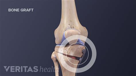Knee Osteotomy Surgery Procedure Arthritis Health