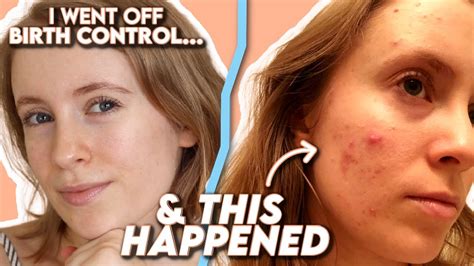 Spironolactone How I Cleared My Hormonal Acne Tretinoin Before After Side Effects