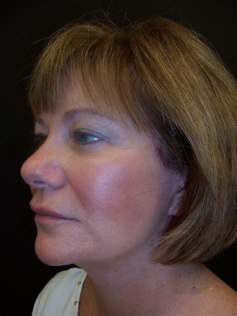 Face And Neck Rancho Santa Margarita Ca Orange County Surgical Specialists