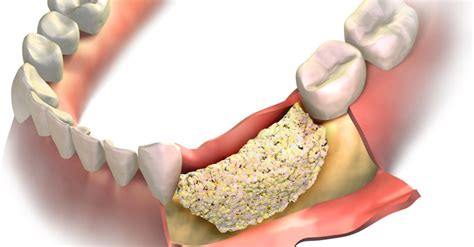 Bone Graft Tooth Extraction What It Is And Recovery Time Suburban Essex