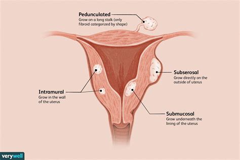 Symptoms And Causes Of Different Uterine Fibroids