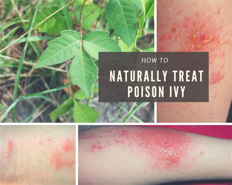 A Natural And Fast Poison Ivy Cure Remedygrove
