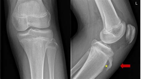 Avulsion Fracture Of The Tibial Tubercle In An Adolescent Eurorad