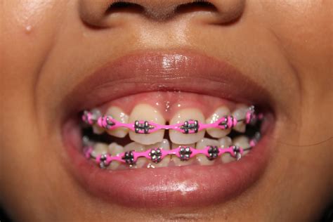 Some people might want their braces to be as difficult to see as possible and for these individuals their best braces colors would be white or tooth colored. Life, Love, Everything: Braces UPDATE!