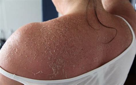 How To Stop Peeling Skin From Sunburn Sunburn Skin Sunburn Peeling