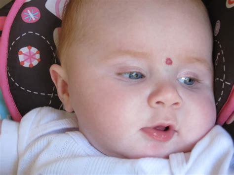Baby Birthmarks Pictures Photos