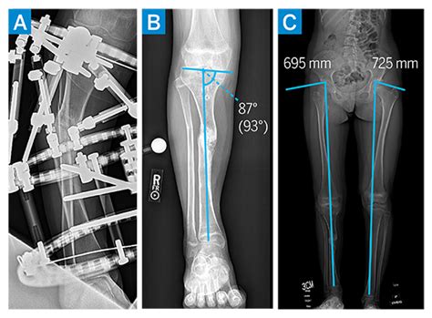 Treating Tibial Nonunion And Multilevel Deformity Hss Case