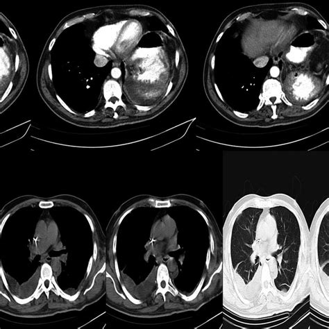 Multislice Spiral Chest Ct Angiography Axial Coronal And Sagittal