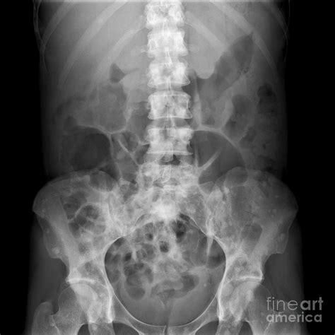 Bone Tumor X Ray