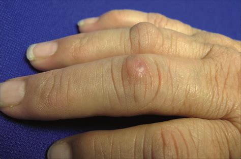 Skin Colored Nodules On The Knuckles —quiz Case Dermatology Jama