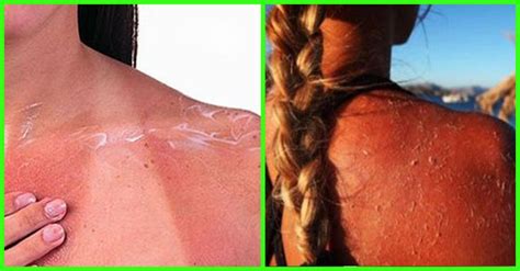514 367 просмотров 514 тыс. 10 Natural Remedies To Treat Sun Poisoning At Home ...
