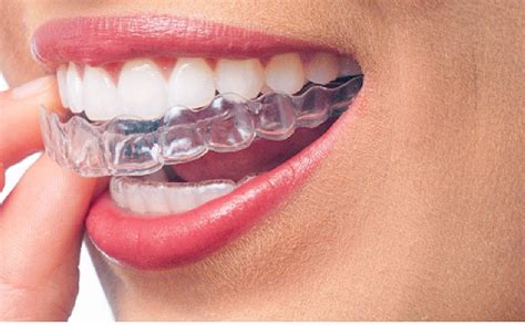3 Things You Should Know About Invisalign Umaxdental