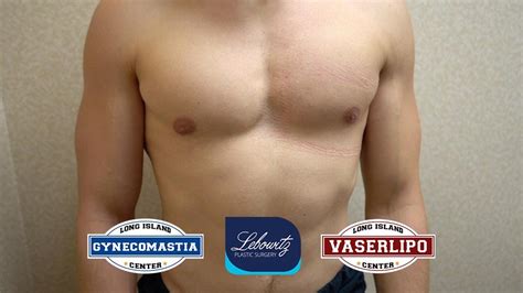 Gynecomastia Surgery Unilateral Gland Removal 24 HOUR POST OP YouTube