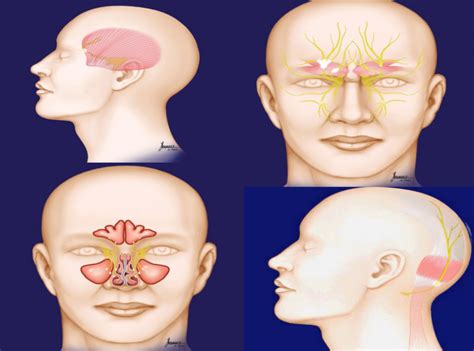 The Surgical Treatment Of Migraine Headaches Migraine Surgery How